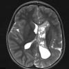 1A2 Malformation, complex Het PMG (Case 1) T2 STEALTH 2