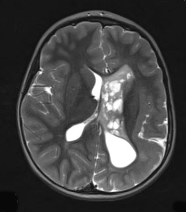 1A2 Malformation, complex Het PMG (Case 1) T2 STEALTH 2