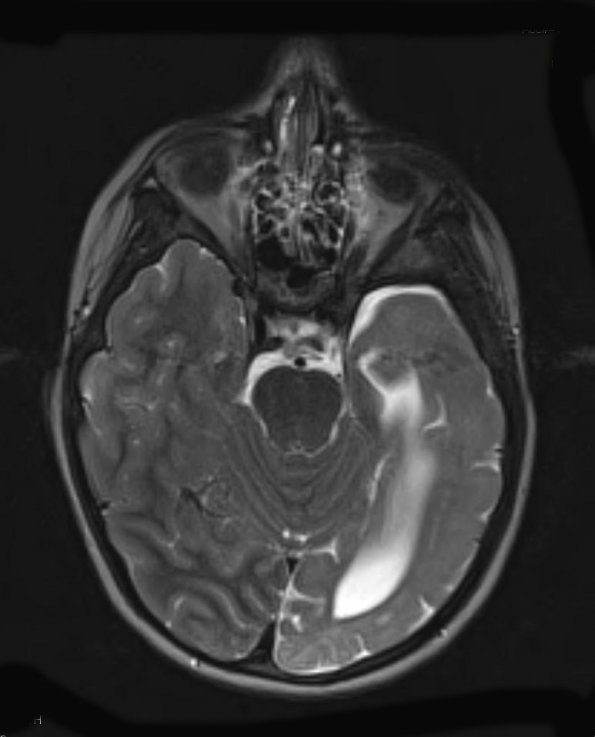 1A3 Malformation, complex Het PMG (Case 1) T2 STEALTH 3