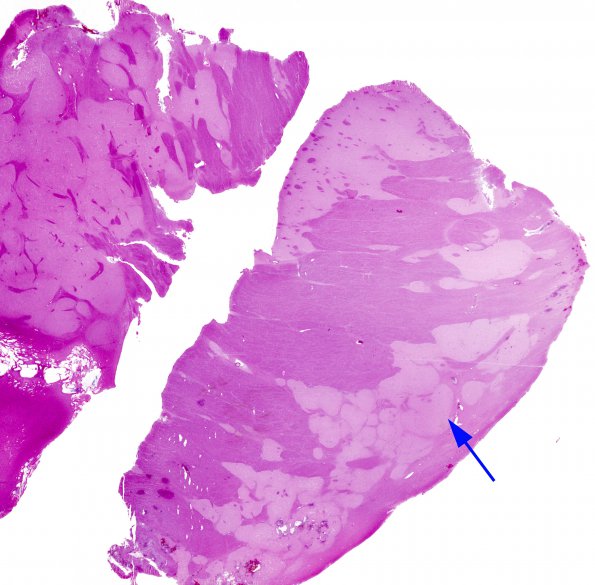 1B1 Heterotopia, glioneuronal, intravent, & PMG (Case 18) H&E whole mount A2