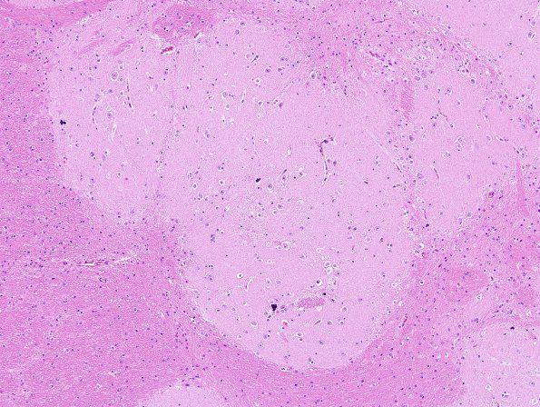 1B3 Heterotopia, glioneuronal, intravent, & PMG (Case 18) H&E 2