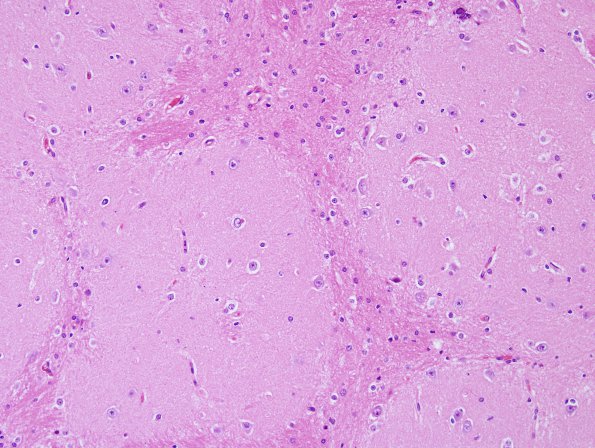 1B4 Heterotopia, glioneuronal, intravent, & PMG (Case 18) H&E 3