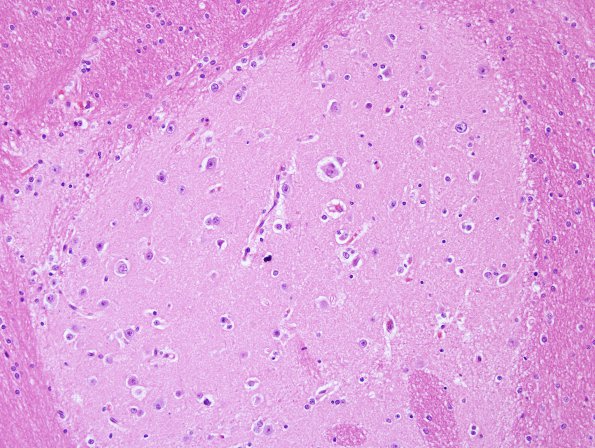 1B5 Heterotopia, glioneuronal, intravent, & PMG (Case 18) H&E 1