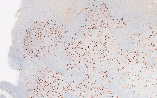 1C4 Malformation, complex Het PMG (Case 1) D4 4X NeuN