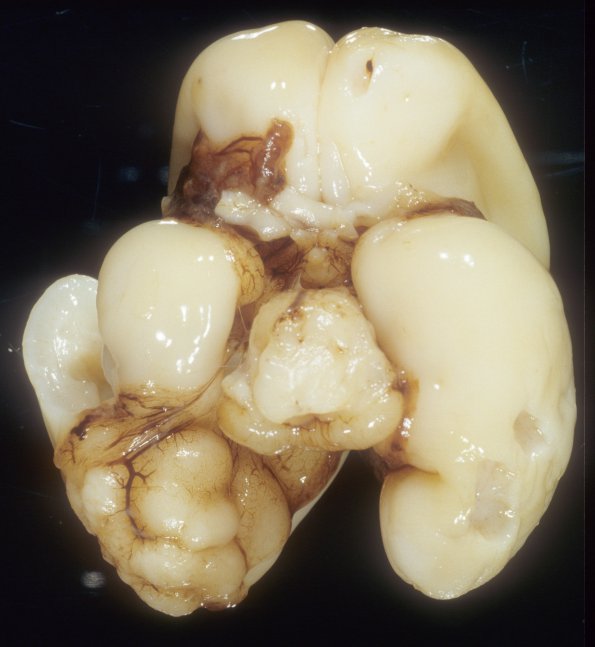 2A1 Malformation, heterotopias (Case 2) A2