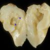 2A2 Malformation, heterotopias (Case 2) A4