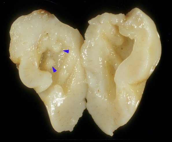 2A2 Malformation, heterotopias (Case 2) A4