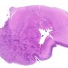 2B1 Malformation, heterotopias (Case 2) N9 H&E whole mount A