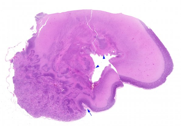 2B1 Malformation, heterotopias (Case 2) N9 H&E whole mount A