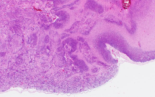 2B2 Malformation, heterotopias (Case 2) N9 H&E 2X