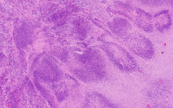 2B3 Malformation, heterotopias (Case 2) N9 H&E 4X