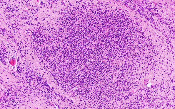 2B4 Malformation, heterotopias (Case 2) N9 H&E 20X