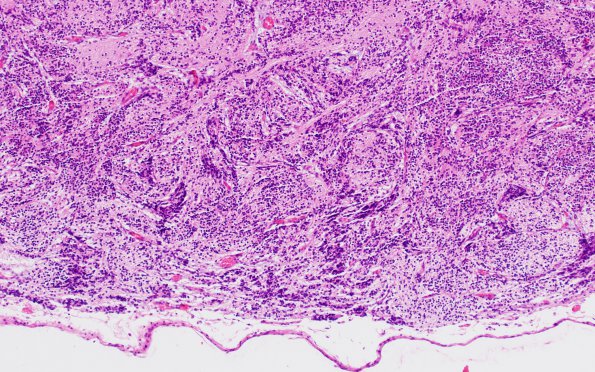 2B5 Malformation, heterotopias (Case 2) N9 H&E 20X 2