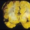 3A1 Hypoplasia-Dysplasia, R cbell, PMG, partial agenesis CC, Heterotopia (Case 3) 14