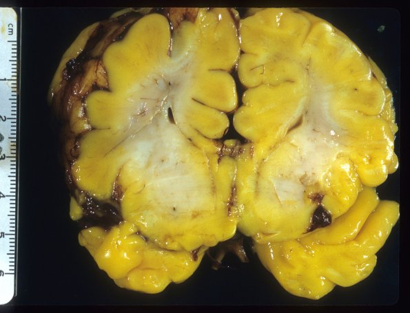 3A1 Hypoplasia-Dysplasia, R cbell, PMG, partial agenesis CC, Heterotopia (Case 3) 14