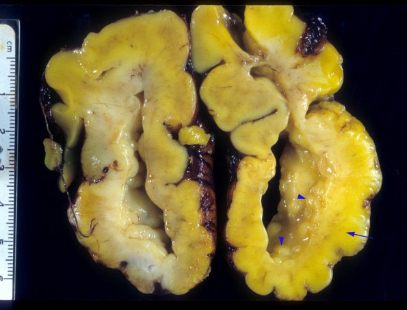 3A2 Hypoplasia-Dysplasia, R cbell, PMG, partial agenesis CC, Heterotopia (Case 3) 5