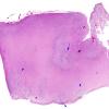 3B1 Hypoplasia-Dysplasia, R cbell, PMG, partial agenesis CC, Heterotopia (Case 3) N7 occipital lobe whole mount 4X