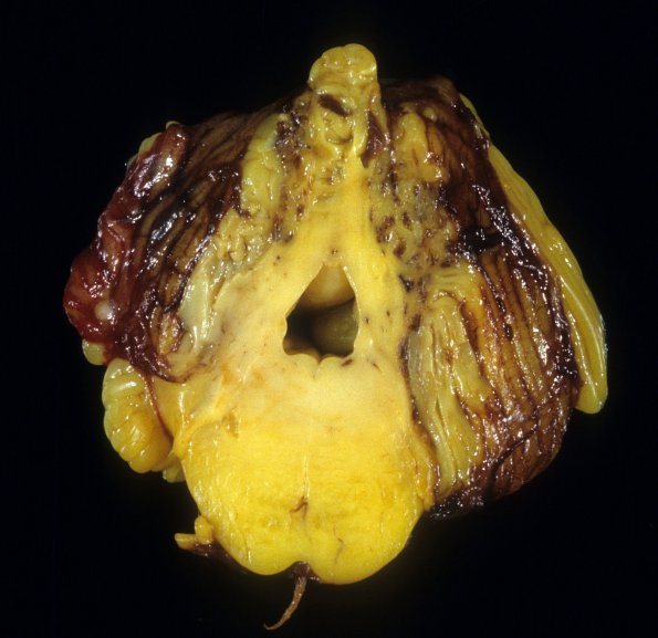 3C2 Hypoplasia-Dysplasia, R cbell, PMG, partial agenesis CC, Heterotopia (Case 3) 8