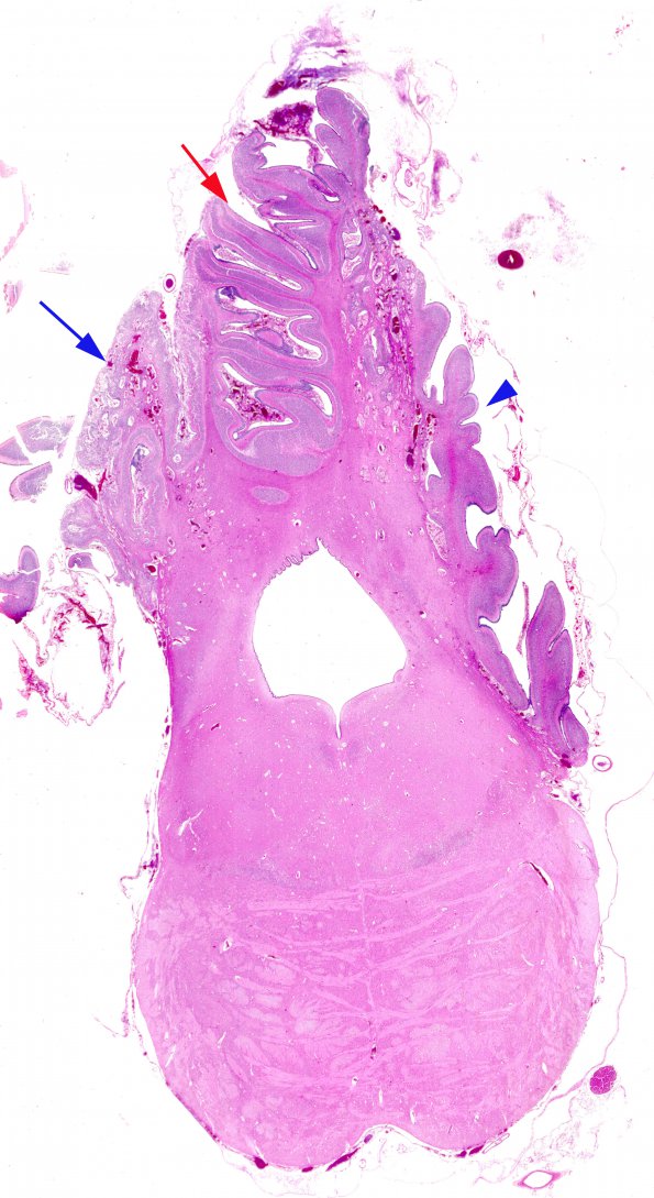 3C3 Hypoplasia-Dysplasia, R cbell, PMG, partial agenesis CC, Heterotopia (Case 3) N10