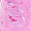 3C4 Hypoplasia-Dysplasia, R cbell, PMG, partial agenesis CC, Heterotopia (Case 3) N10 1