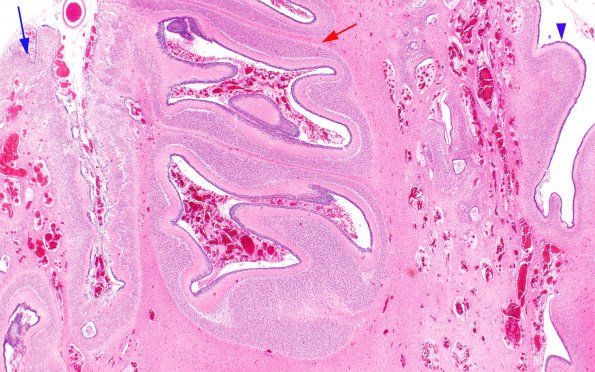 3C4 Hypoplasia-Dysplasia, R cbell, PMG, partial agenesis CC, Heterotopia (Case 3) N10 1