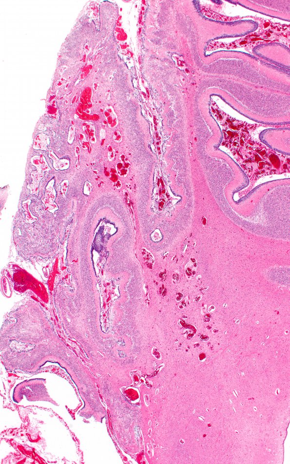 3C5 Hypoplasia-Dysplasia, R cbell, PMG, partial agenesis CC, Heterotopia (Case 3) N10 3