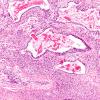 3C6 Hypoplasia-Dysplasia, R cbell, PMG, partial agenesis CC, Heterotopia (Case 3) N10 3