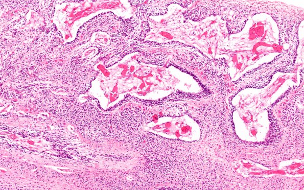 3C6 Hypoplasia-Dysplasia, R cbell, PMG, partial agenesis CC, Heterotopia (Case 3) N10 3