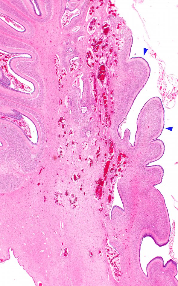 3C7 Hypoplasia-Dysplasia, R cbell, PMG, partial agenesis CC, Heterotopia (Case 3) N10 2