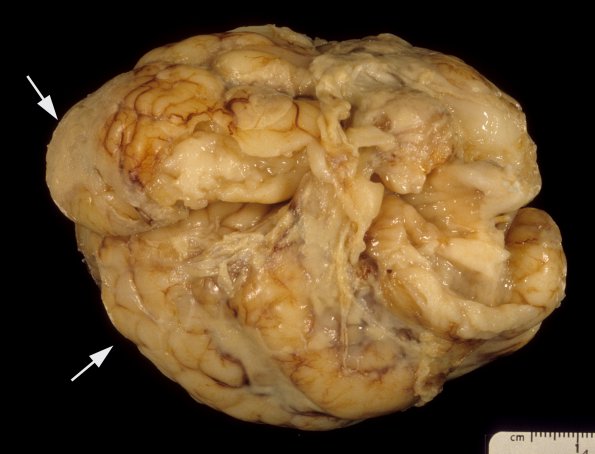 4A Malformation, acrania, encephalocele, heterotopia (Case 4) 3