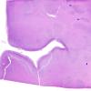 4B1 Malformation, acrania, encephalocele, heterotopia (Case 4) H&E N5 occipital