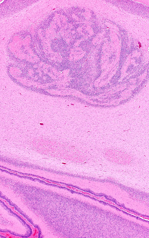 4B4 Malformation, acrania, encephalocele, heterotopia (Case 4) H&E N6 cerebellum 4X 2