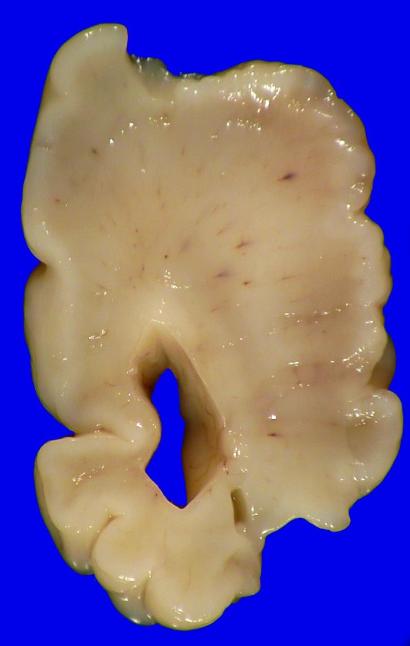 5A1 (Case 5) A.004
