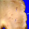 5A2 (Case 5) Gross