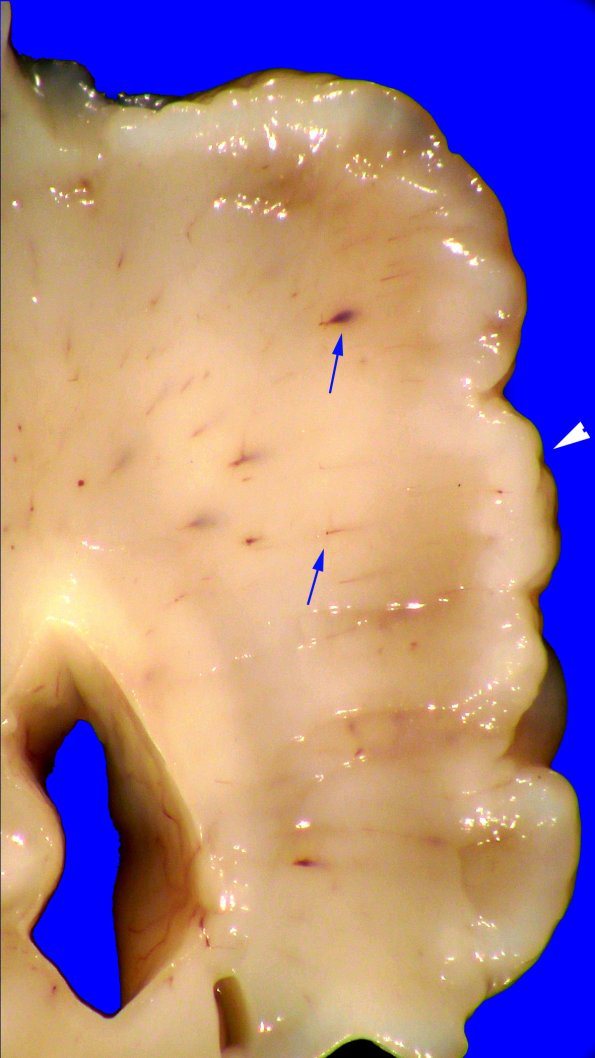 5A2 (Case 5) Gross