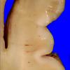 5A3 (Case 5) A.009