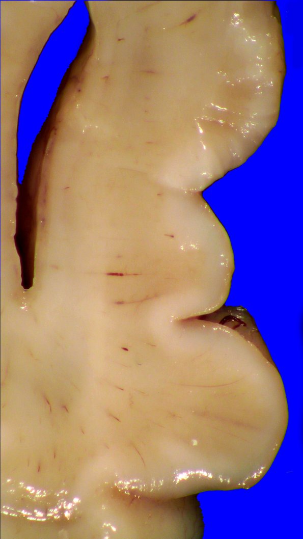 5A3 (Case 5) A.009