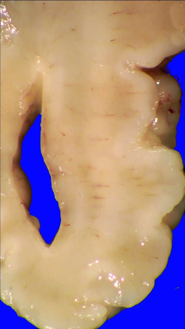 5A4 (Case 5) A.011