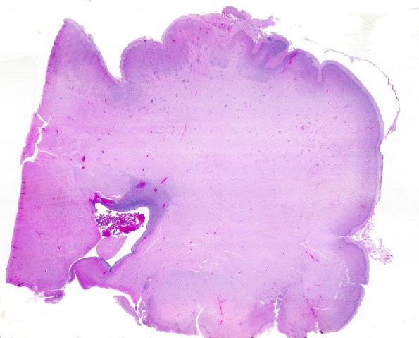 5B2A Malformation (Case 5) H&E A1 WM