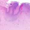 5B2B Malformation (Case 5) H&E A1 2X 2