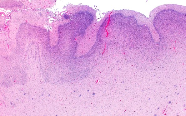 5B2B Malformation (Case 5) H&E A1 2X 2
