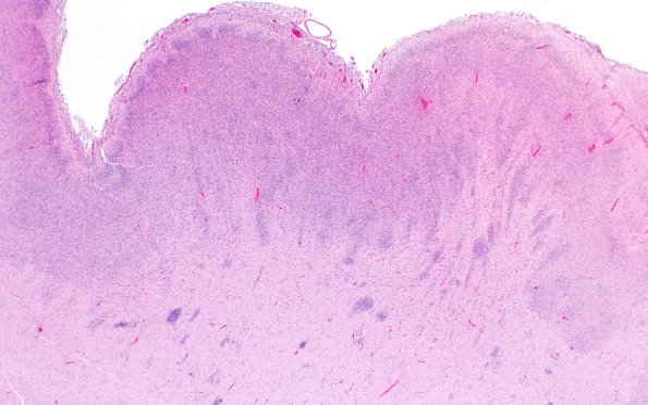 5B2C Malformation (Case 5) H&E A1 2X 3