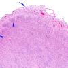 5B2D Malformation (Case 5) H&E A1 4X copy