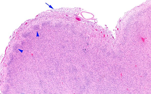 5B2D Malformation (Case 5) H&E A1 4X copy