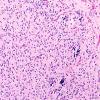 5B2E Malformation  (Case 5) H&E A1 20X 2