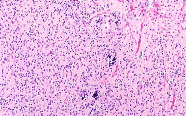 5B2E Malformation  (Case 5) H&E A1 20X 2