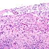 5B2F Malformation (Case 5) H&E A1 20X