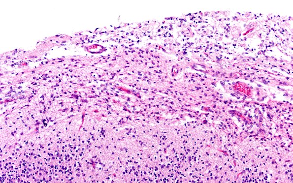 5B2F Malformation (Case 5) H&E A1 20X