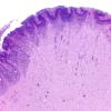5B3 Malformation (Case 5) H&E A4 2X 3