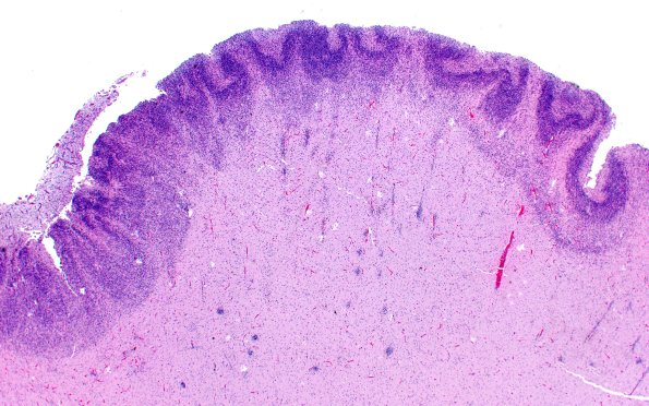 5B3 Malformation (Case 5) H&E A4 2X 3